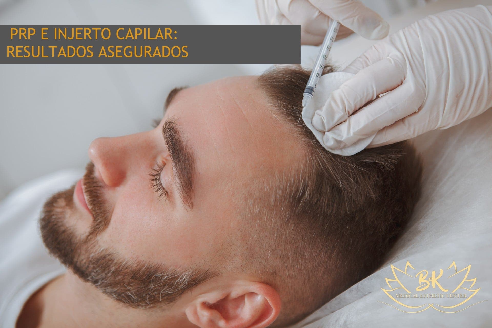 PRP e Injerto Capilar: dúo de oro para recuperar tu cabello
