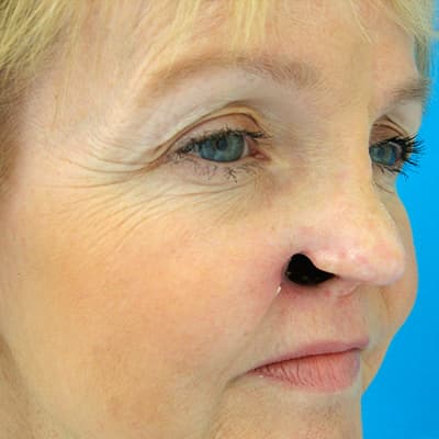 Custom Prosthetic, Ltd. | Gallery of nose prosthetics