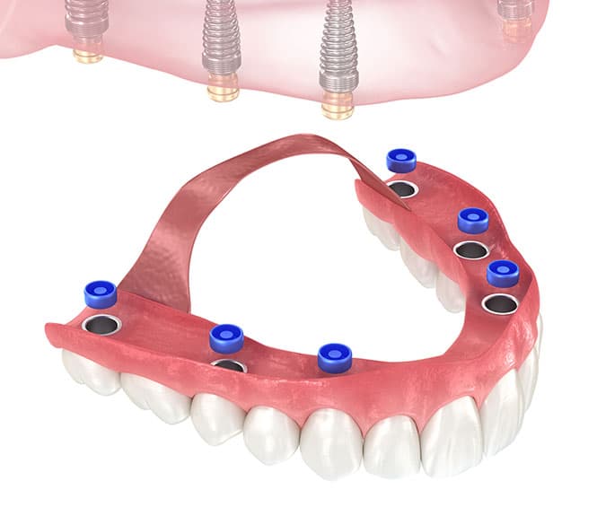 Dental Implant Overdentures - Precision Periodontal and Implant Center