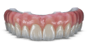 Glidewell Implant Solutions BruxZir Full-Arch Implant Prosthesis