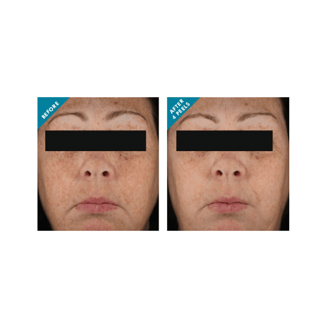 📸Before & After - @SkinCeuticals Advanced Corrective Peel http ...