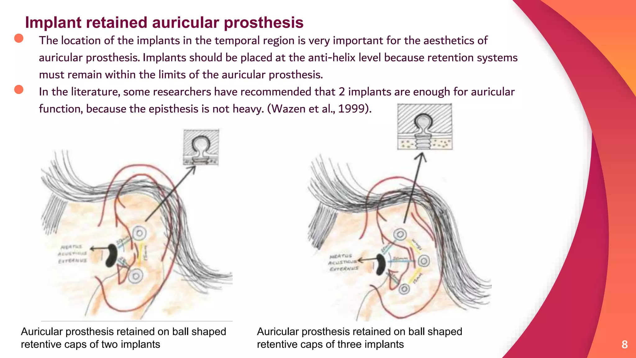 Implant Retained Auricular Prostheses in Canada: Innovative Solutions ...
