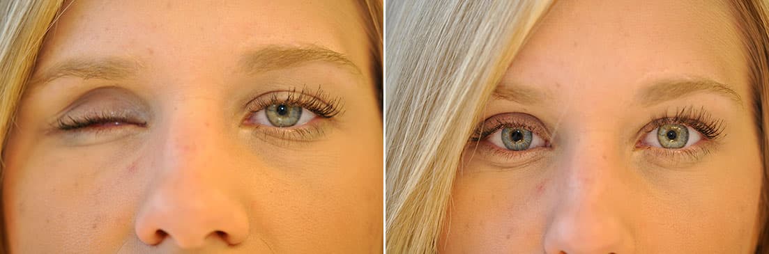 Ocular Prosthetic