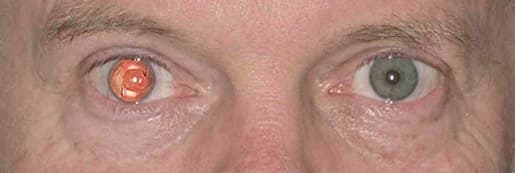 The ARTIFICIALIRIS for your patients with aniridia | HumanOptics