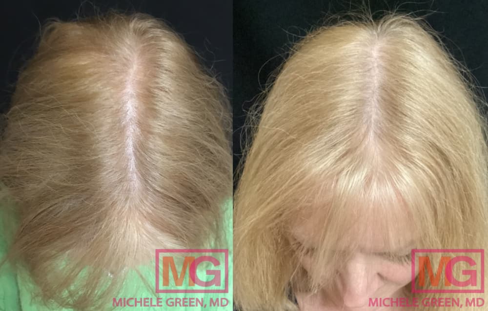Female Hair Loss Treatment, Pattern Baldness & PRP Treatment for Women