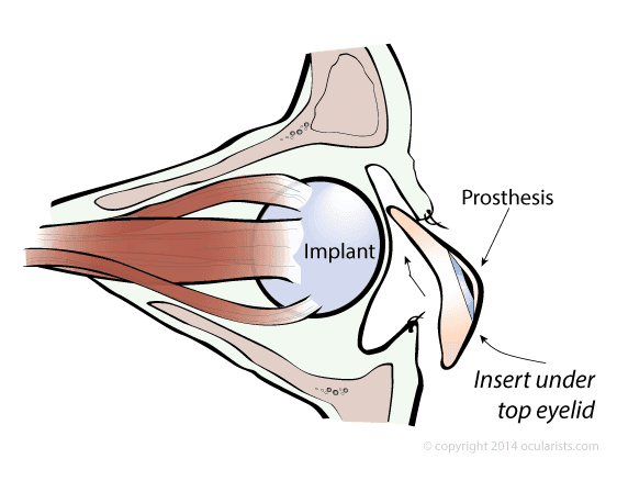 Prosthetic Eye Steps – Preparing for Eye Surgery - Ocularist Info ...