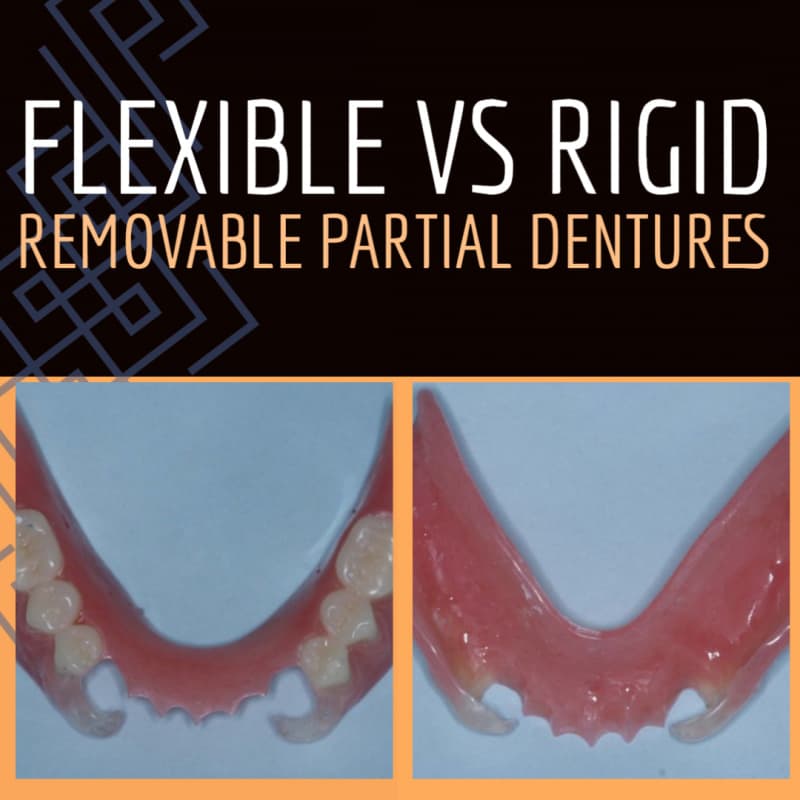 Flexible vs. Rigid Removable Partial Dentures - S2538 - CE Video ...