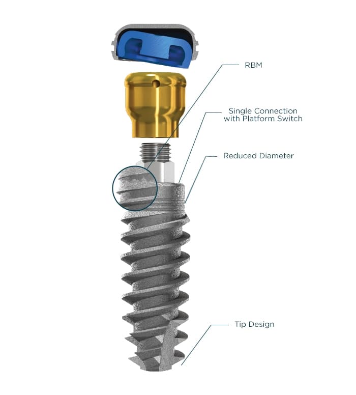 LOCATOR Overdenture Implant System | Zest Dental Solutions